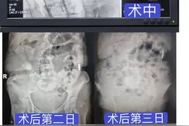 郴州一医微创介入诊疗拯救结肠癌术后肠梗阻患者：小小导管解决大问题图片