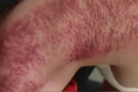 刮痧真的有用吗？图片