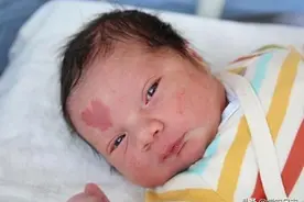 婴儿如何避免“胎记”？女医生：孕期不做这3种行为，孩子会谢你图片
