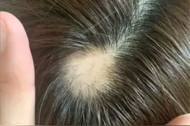 沈梦辰自曝“秃头”照，网友纷纷晒同款！专家回应可自愈图片