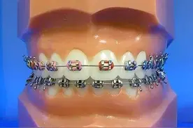 牙套的种类都有哪些？哪个矫正器矫正牙齿比较好。图片