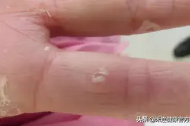 手脚脱皮，是需要补啥么？图片