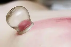 在拔火罐时，后背吸出来的瘀血，真的是毒素吗？真相来了图片