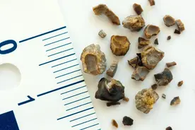 泌尿科医生给结石划了“疼痛等级”，长在这个位置的更危险图片