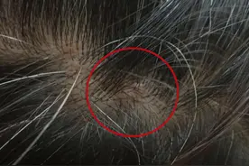 为什么头皮总长“疙瘩”和“脓包”？或与4个原因有关图片