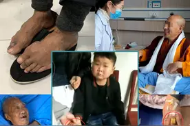 “亡羊补牢”治痛风石也不晚，因时制宜选择保守治疗、微创手术图片