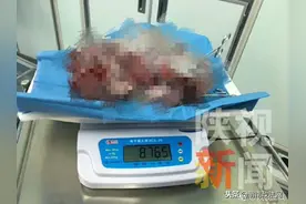 怕怕！腹胀体重却减轻 到医院一查 20岁女孩腹中取出8.8公斤巨大畸胎瘤图片