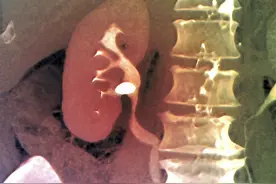 体外冲击波碎石，为什么有些结石碎不掉，反而碎坏了身体图片