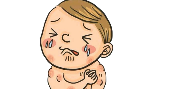 病情严重者可伴有心慌,烦燥,恶心,呕吐甚至血压降低等过敏性休克表现.