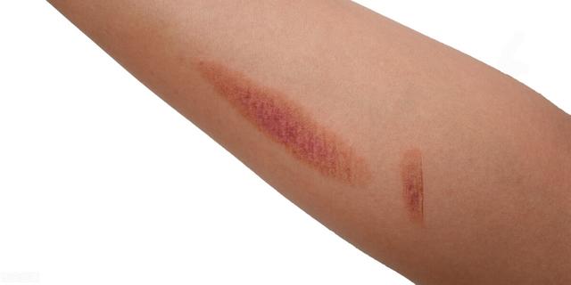 烫伤后留下了黑黑的一片怎么办?