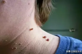 脖子上、耳朵上的“小肉瘤”是什么？如何处理？一文说清楚图片