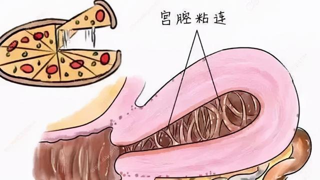 做阴超可以看出宫腔粘连吗?