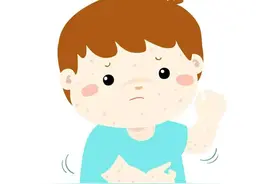 水痘知识知多少？世界卫生组织建议，提前给孩子接种水痘疫苗图片