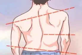 脊柱侧弯多少度需要手术？来看这篇文章图片