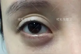 眼窝凹陷填充后的改变到底有多大？来看看她们填充术后的变化图片