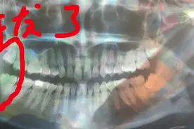 拔智齿记之酸爽图片