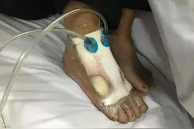 冬天了蛇咋还没冬眠？农妇山上锄草被蝮蛇咬伤图片