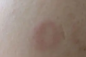 脸上突然长了个“圆圈状红斑”，到底是咋回事？看医生怎么说！图片