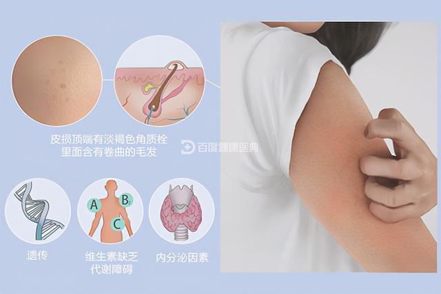 毛周角化正有没有遗传