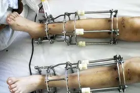 当年那个花16万锯断骨头，只为长高7厘米的人，现在怎么样了？图片