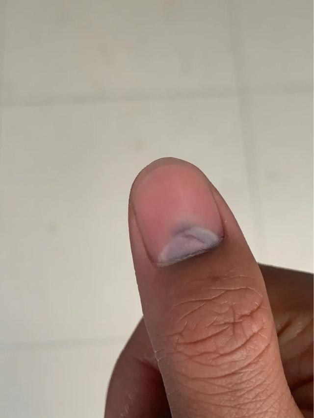 指甲盖被砸了有瘀血怎么办