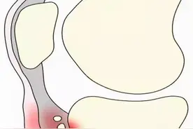 胫骨结节骨骺炎是怎么一回事？图片