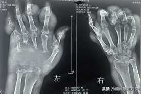 长痛风石后没必要做手术，因为切了还会再长？您有规范降尿酸吗？图片