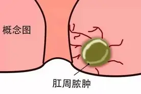 肛周脓肿12345678图片