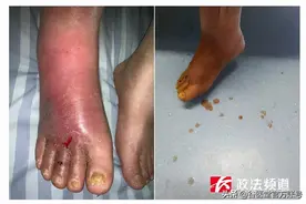 烂脚、截肢、失去生命——糖尿病足可能出现的后果太可怕图片