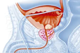 61岁男士排尿困难到泌尿科就诊，医生直言：大多数都有这难言之隐图片