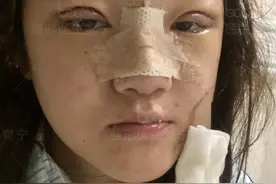 22岁小妹双眼皮隆鼻术后30天，朋友说换了一张脸图片