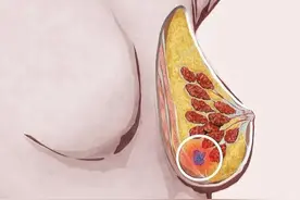 乳腺微创手术到底怎么做？图片