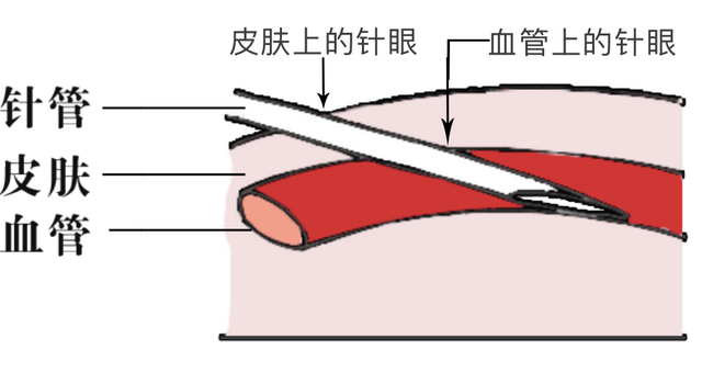 辟谣：输液好得快、通血管？输液的10个真相，一次说清
