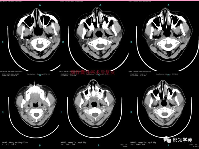 腮腺角化型鳞癌
