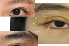 双眼皮眼尾出现了一个奇怪的鼓包，这是怎么回事？可以修复好吗？图片