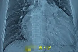 心脏大如牛心脏，原来是里面就缺少“一面墙”图片