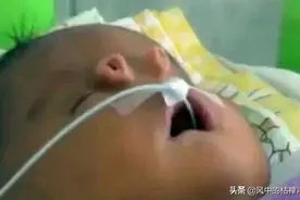 宝宝出生后，该长鼻子的地方没有长鼻子，却长着2根“小管子”图片
