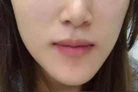 3次祛斑经验，终于和斑点说再见了图片