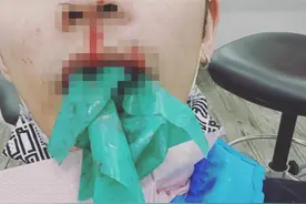 鼻孔下出现大洞！32岁人气男星紧急入院治疗：头骨已被细菌侵蚀图片