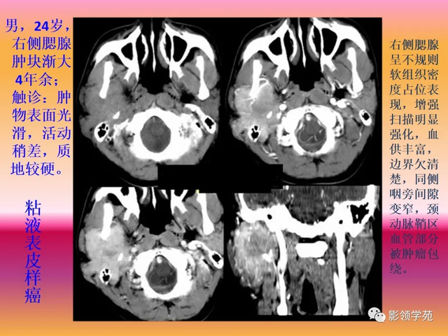 腮腺角化型鳞癌
