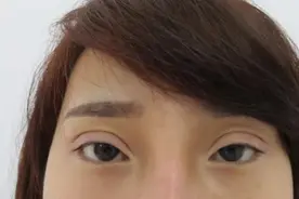 双眼皮手术后不好看，再修复一下不就行了吗？图片