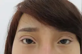 双眼皮手术后不好看，再修复一下不就行了吗？图片