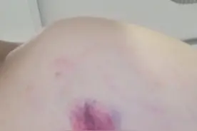 和女朋友吵架闹分手，被她咬伤了怎么办图片