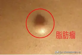 什么是脂肪瘤，它会癌变吗，我们应该怎么正确治疗脂肪瘤图片