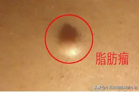 什么是脂肪瘤，它会癌变吗，我们应该怎么正确治疗脂肪瘤图片