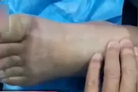 男子醉酒睡街头，四肢冻僵面临截肢，同桌饮酒该担责吗？图片
