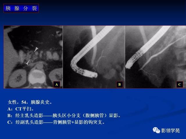胰腺的解剖与常见变异