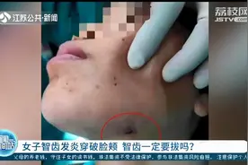 扬州女子智齿发炎硬扛好几年，左侧脸颊被脓肿穿破 智齿一定要拔吗？图片