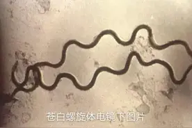 带你了解一下什么是梅毒图片