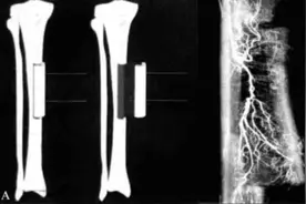 从腿上切一块骨头，拉出来再按回去，就能治疗糖尿病下肢坏死？图片